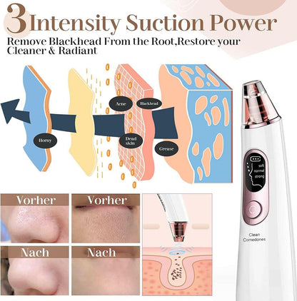 Electric Blackhead Remover Vacuum: Pore Cleaner Kit - Glow Pure